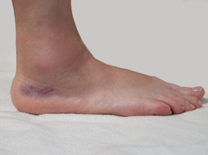 Ouch! I Rolled My Ankle In, Now What Do I Do?